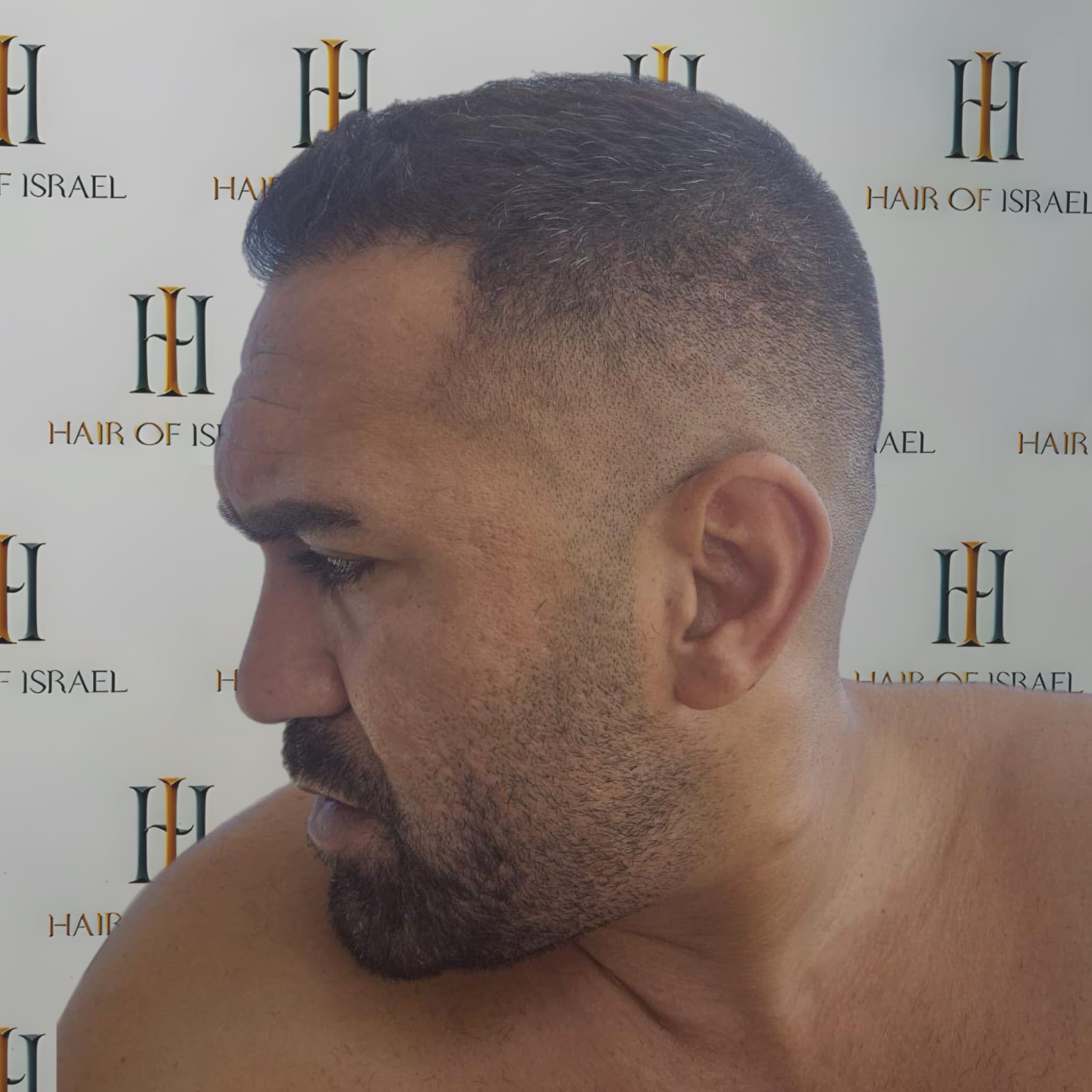 אחרי השתלה — מטופל 2