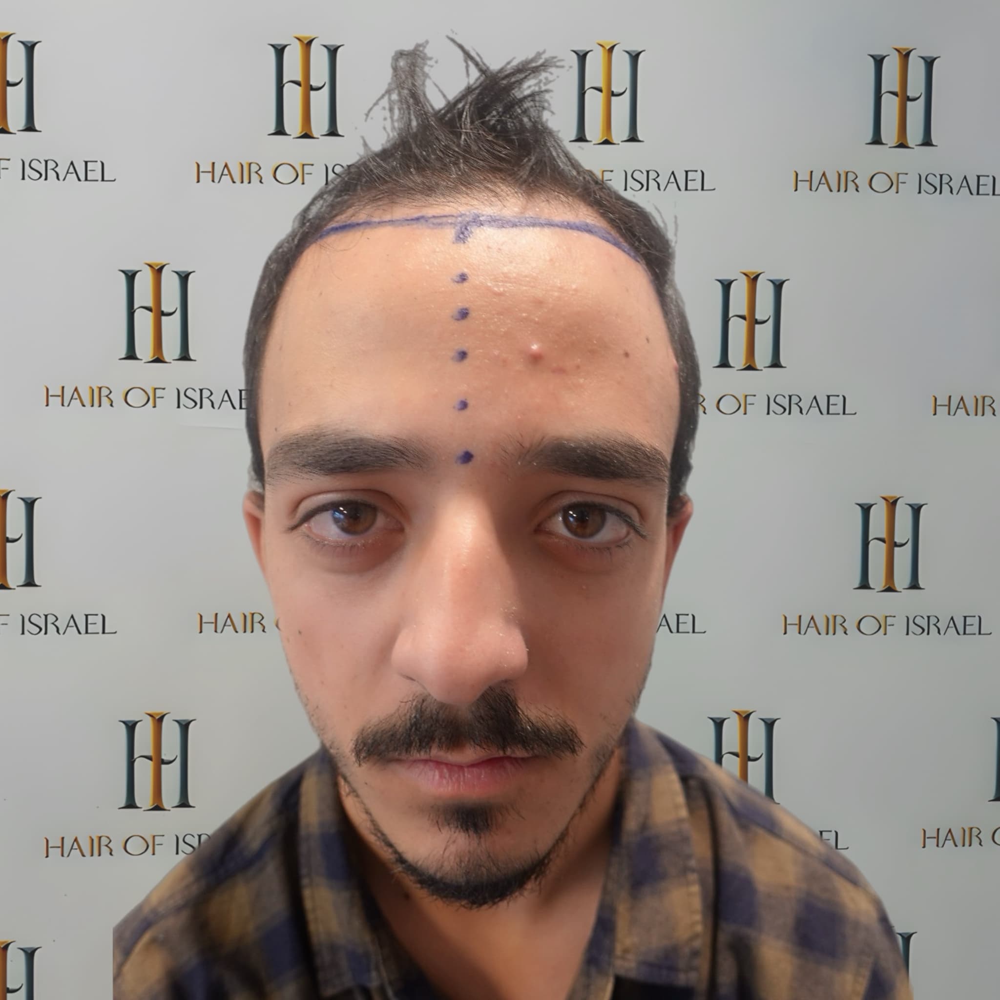 לפני השתלה — מטופל 6