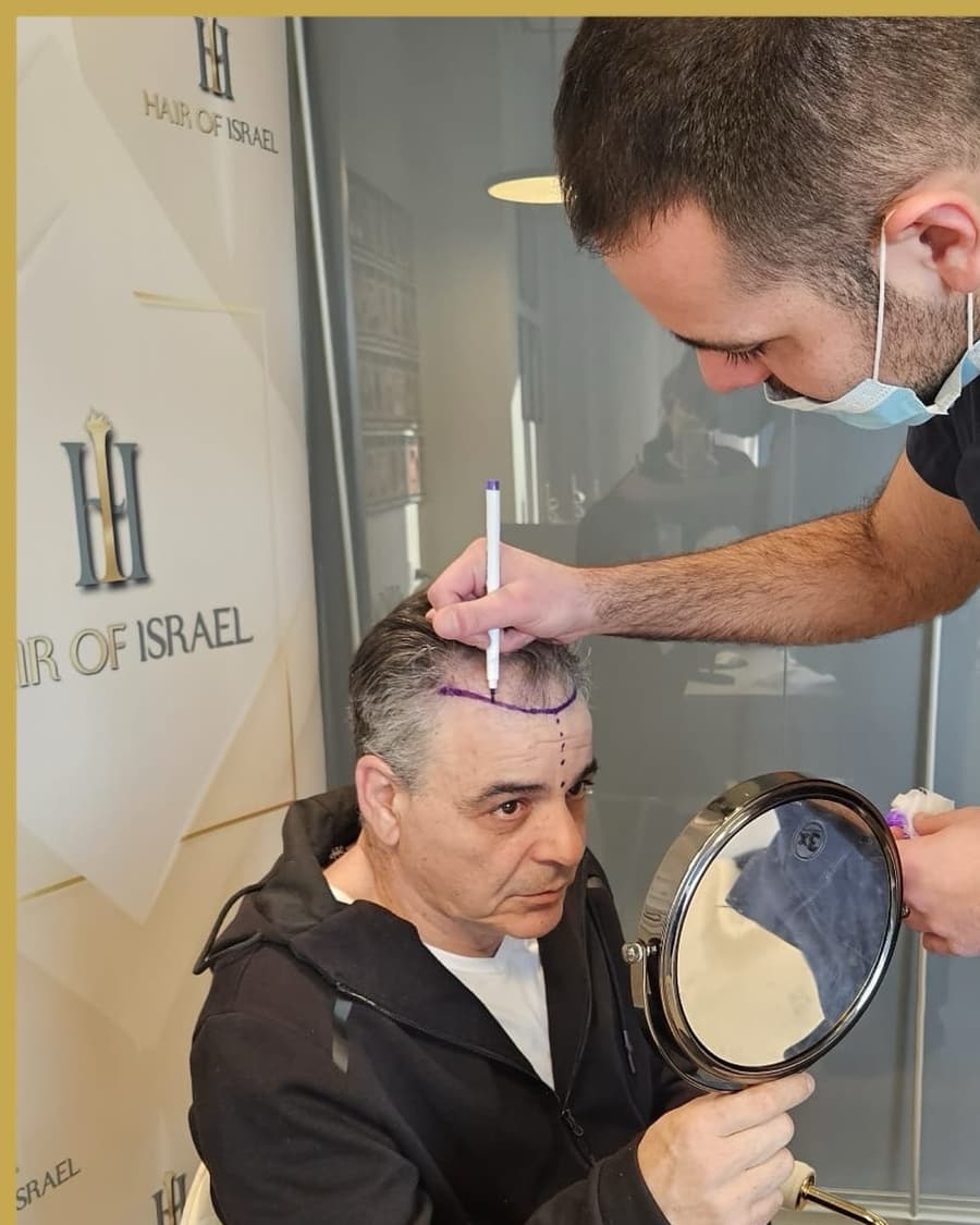 סרטוט קו שיער חדש למטופל לפני ההשתלה